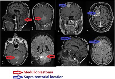 Glioblastoma Following Treated Medulloblastoma After 29 Years in the Posterior Fossa: Case Report and Review of Literature